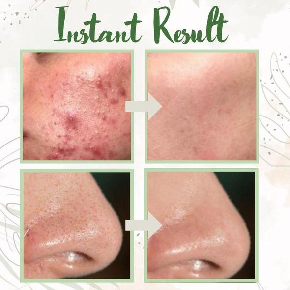 (🔥LAST DAY SALE-80% OFF)Final Sale -Insideefy Holy Basil Bubble Deep Mask 13%